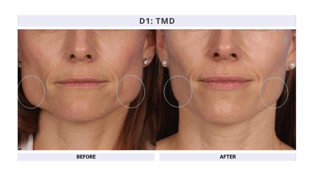 TMD Treatment using Botox