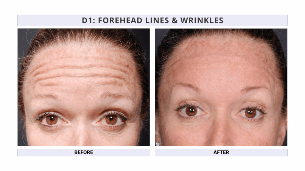 Forehead lines and Wrinkles