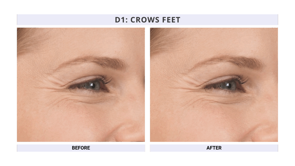 Crows Feet treatment using Botox