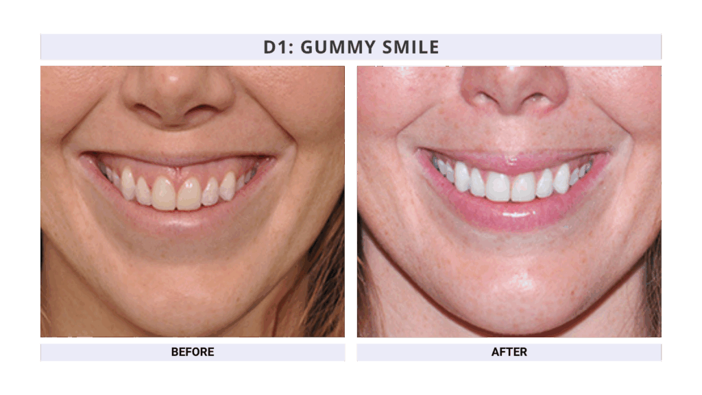 Gummy Smile Treatment using Botox Dental CE