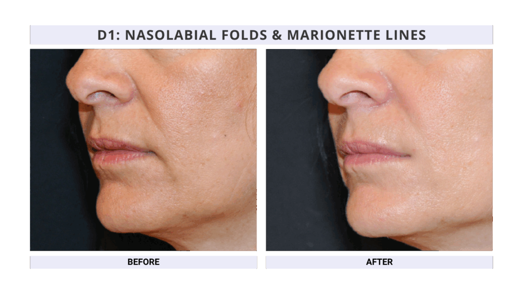 Nasolabial Folds and Marionette lines Treatment Using Dermal Fillers