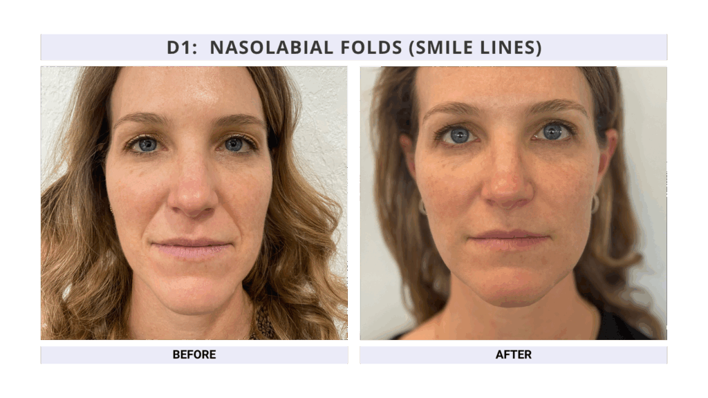 Nasolabial Folds Treatment using Fillers