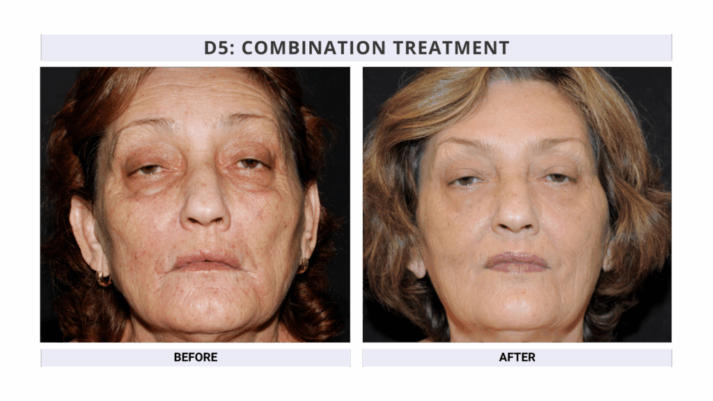 Advanced Facial Aesthetics Training for Dentists Before and After Treatment