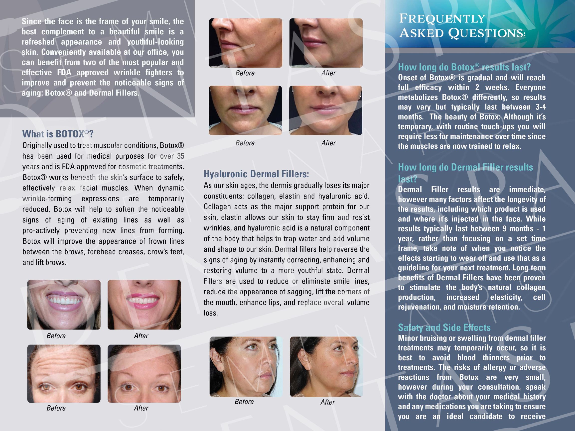 Brochure inside for BOTOX And Dermal Fillers