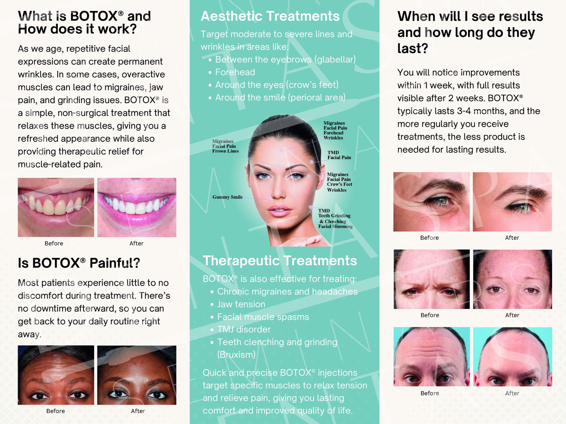 inside of Botox Brochure