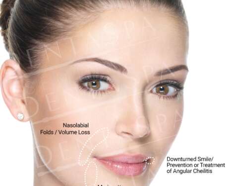 Dermal Fillers A Poster