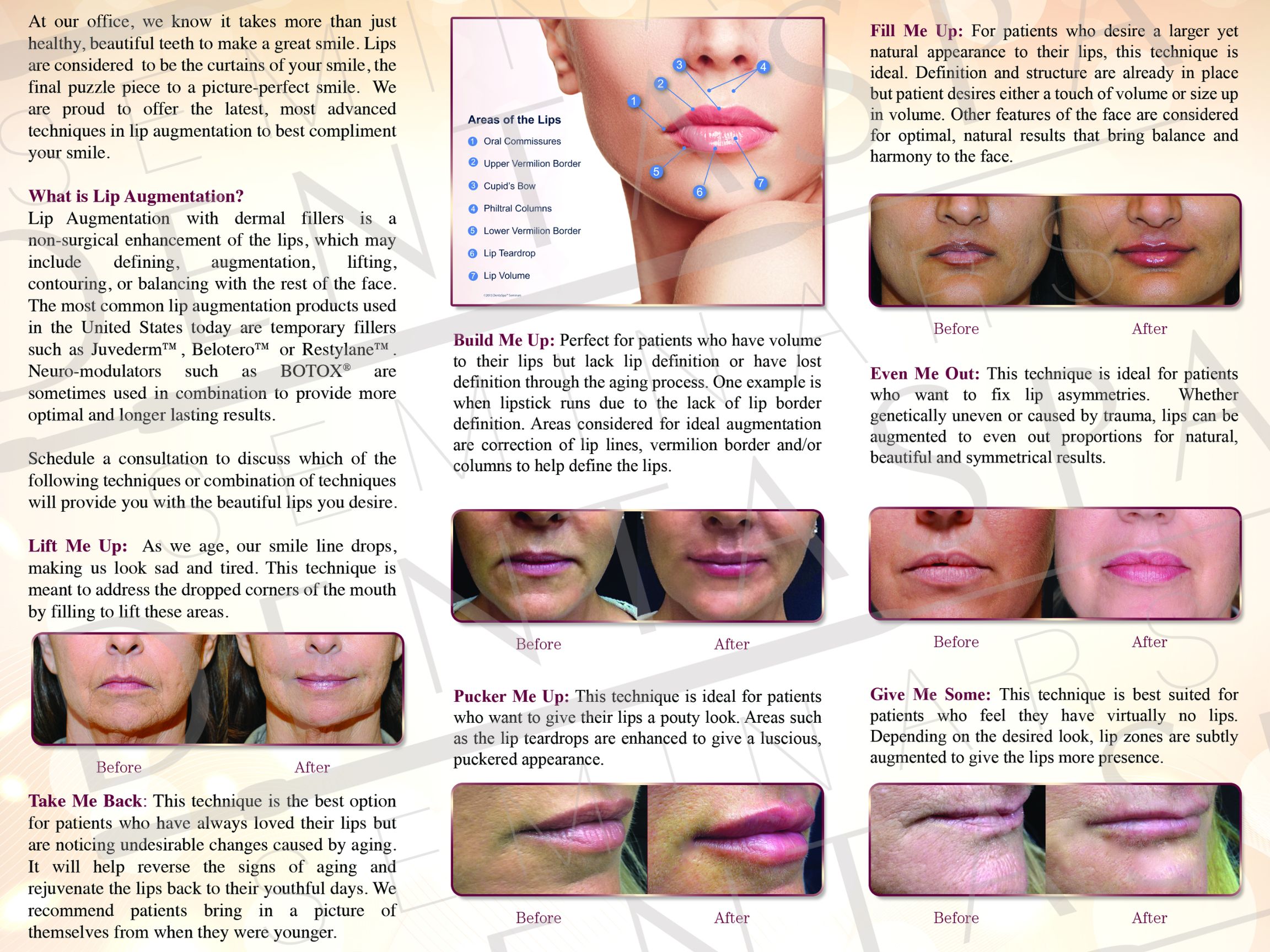 Lip Augmentation Brochure Inside