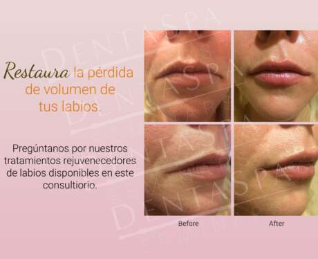 Pérdida de Volumen Labios Poster