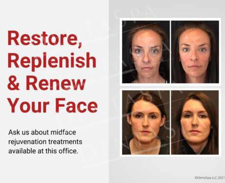 Young Midface Poster