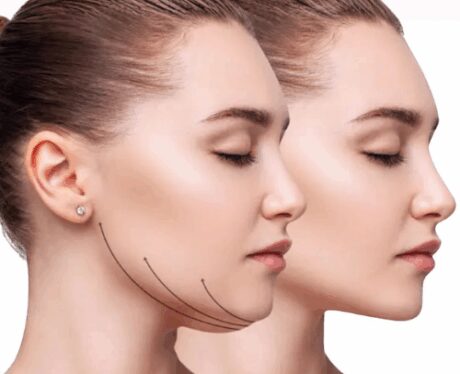 Kybella Deoxycholid Acid