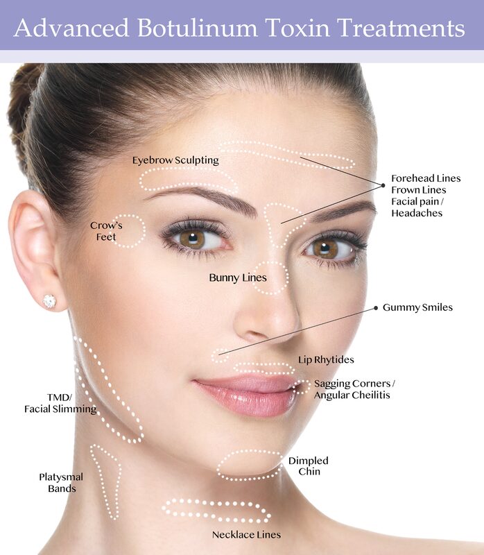 Botox Treatment Chart