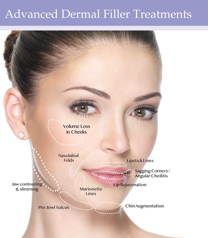 Advanced Filler Treatment chart